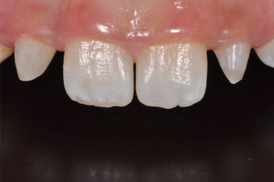 Cosmetic Bonding Halifax, NS Dr. Jenine Arab Omalley